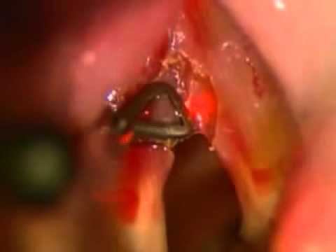 comment soigner nodule cordes vocales