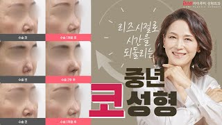 #중년코성형 ⭐ 뭔가 다른 중년美 트렌드?! #아이루미성형외과