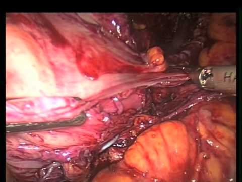 Laparoskopowa plastyka nawrotowej przepukliny rozworu przełykowego po gastroplastyce Collisa z powodu ciężkich zaburzeń połykania