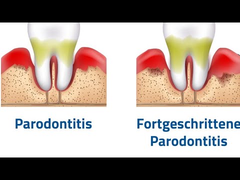 Parodontitis, Ursachen, Risikofaktoren, Behandlung und Therapie