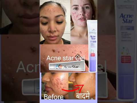 Acnestar gel  ||  Acnestar gel for pimples and acne || how to use acnestar #viralvideo  #health