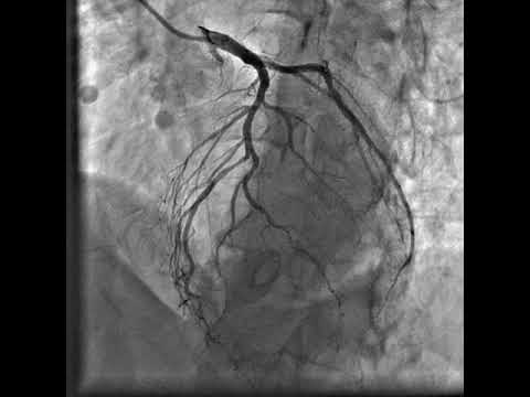 RCA CTO intervention