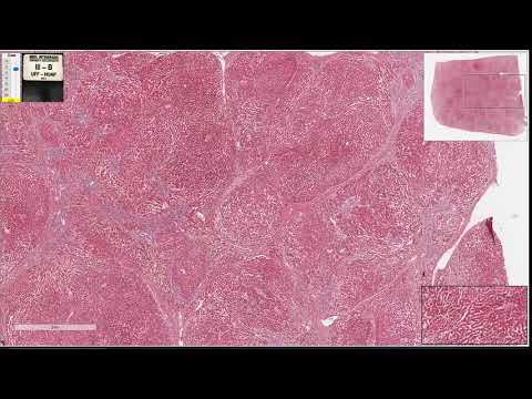 Cirrose Hepática - Patologia Geral