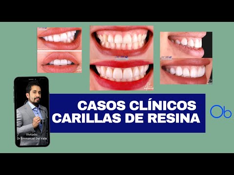 Casos Clínicos de Carillas de Resina