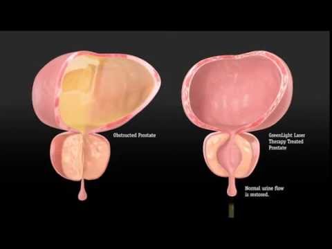 Übungen für Dr. Bubnovskaya Prostata Klicken Sie auf die Prostata
