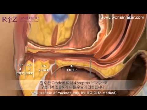 아시아 최초 레이저질성형 수술영상
