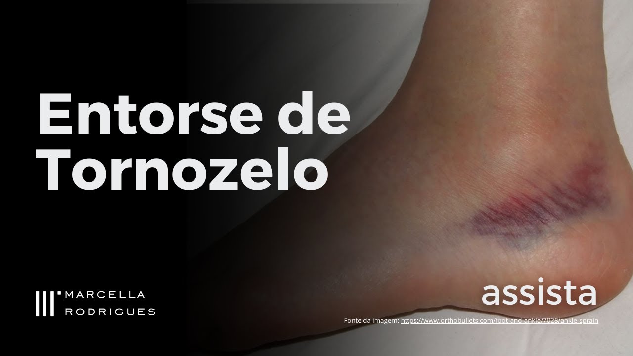 Entorse de TORNOZELO: Tudo o que você precisa saber