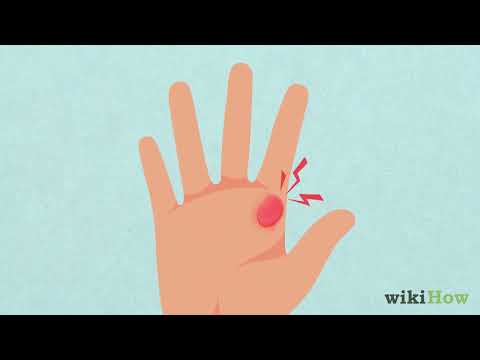 How to Treat a Blister