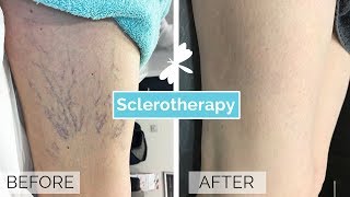 Sclerotherapy Leg Vein Treatment | The Laser and Skin Clinic