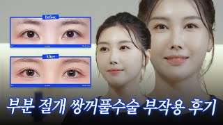 부분절개 쌍수 배신 쌍꺼풀수술 풀림 부작용으로 재수술 후기