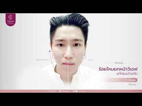 ร้อยไหม หน้าเรียว