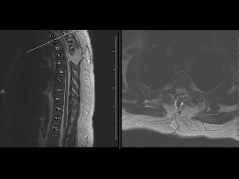 Kyste arachnoïdien spinal - traitement des diagnostics différentiels d'imagerie