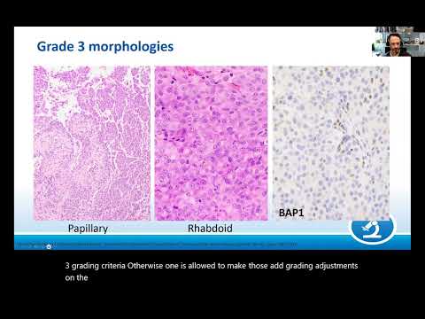 AANP Teaching Rounds - March 28 - Common Mesenchymal Neoplasms in and around the CNS