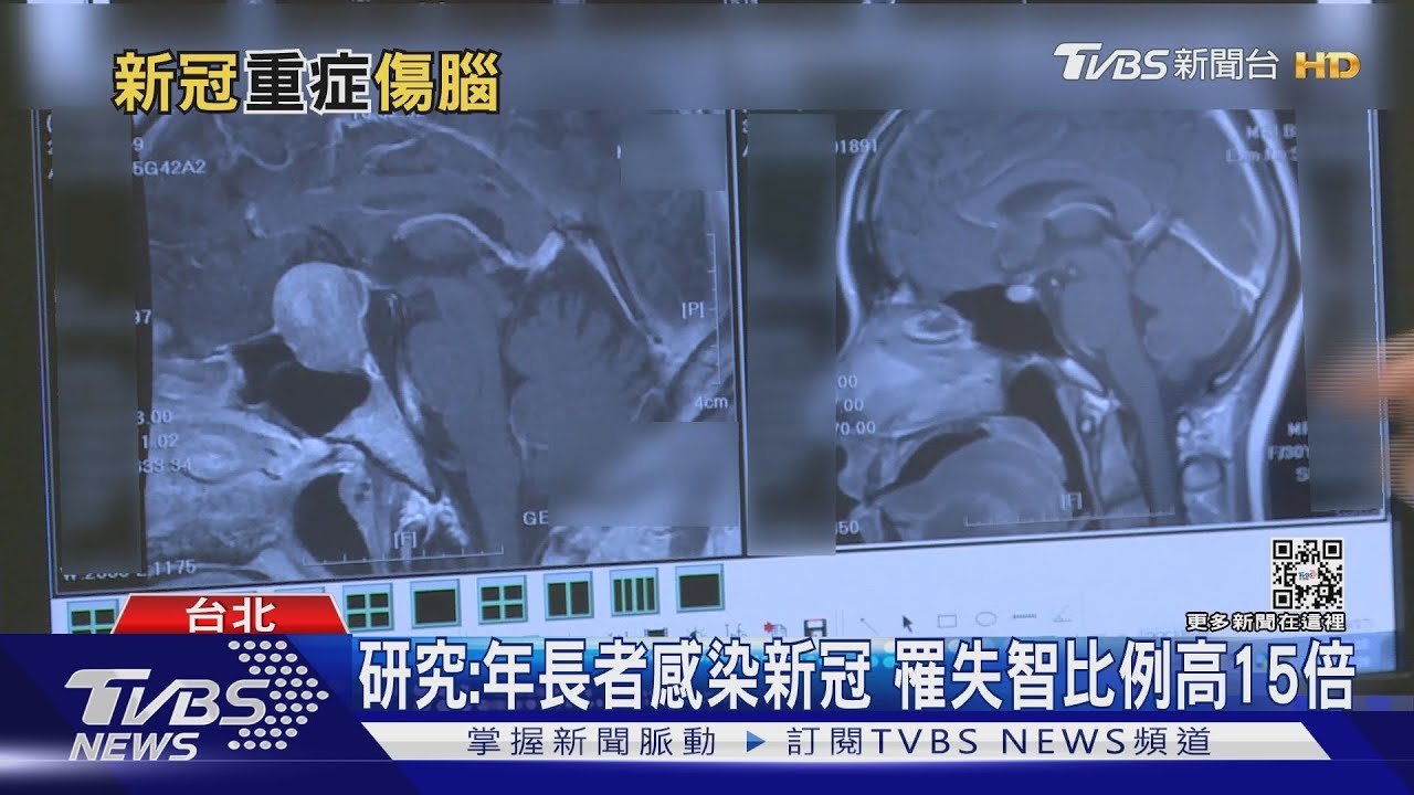 染上這疾病出院後 罹患失智症比例高15倍