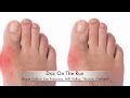 What is the Best Way to Diagnose Gout in the Foot ...