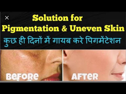 Herbal Anti Pigmentation Fairness Cream