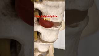 Lower back pain | L4-L5, L5-S1 Problem | Slip disc, Disc Bulge, Sciatica #shorts