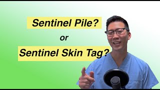 What is a Sentinel Pile or Sentinel Skin Tag? | Dr. Chung explains!
