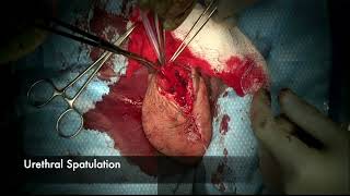 Core Videos (2025): Penile Resurfacing: The Urethral- Neoglans Procedure