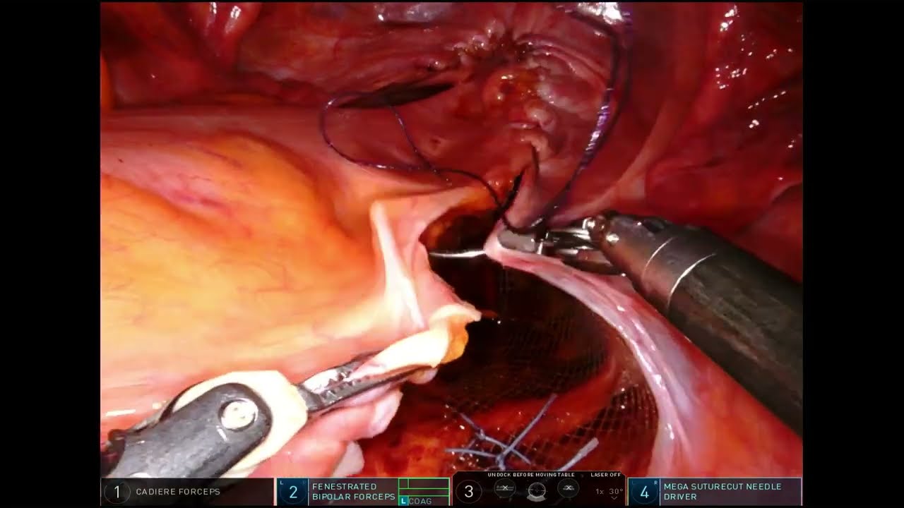 Robotic Ventral Mesh Rectopexy