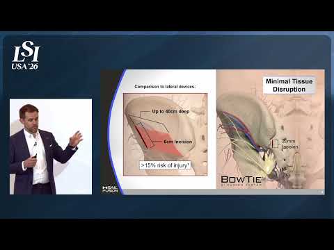 David Jansen, SAIL Fusion - SI joint fusion system using AO principles | LSI USA '26