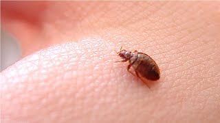 how to get rid of bed bugs bites on your skin fast