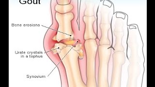 Gout