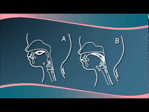 Chapter 3 - Understanding Cleft Lip/Palate Physiology