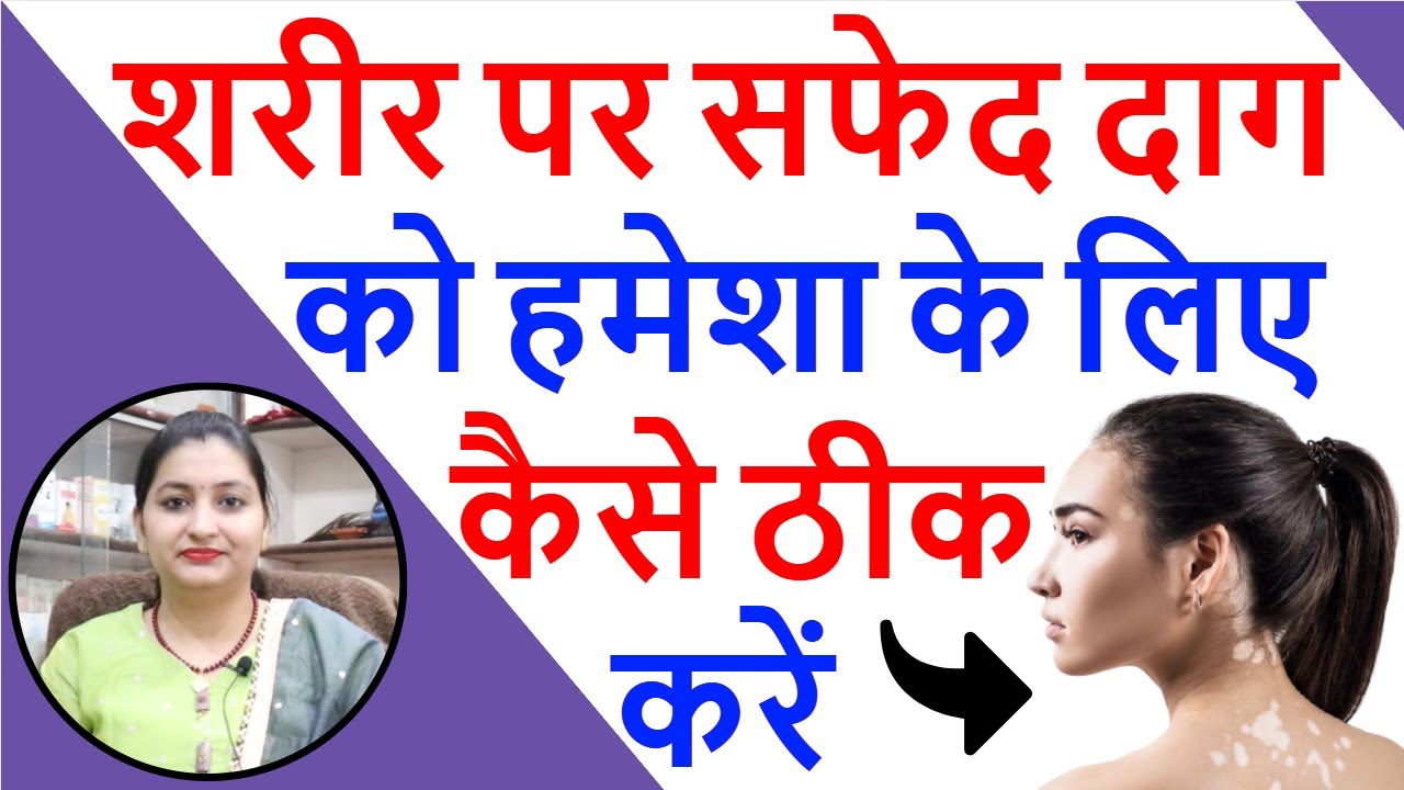 सफेद दाग या विटिलिगो का इलाज कैसे करें | Homeopathic Medicine for Vitiligo | Arsenic Sulph Flavum