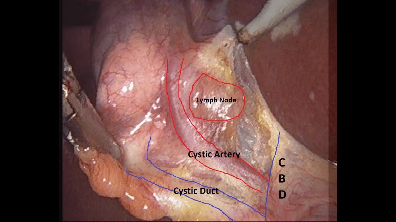 Laparoscopic Cholecystectomy 33M