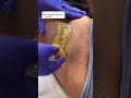 Sugaring Vs Waxing Waxing Underarm Using DIY Sugar Wax Shorts