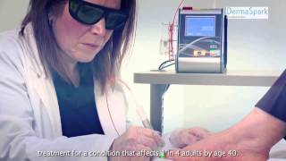 Cure Nail Fungus with FOX Laser Treatments!