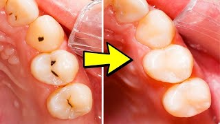 How To Heal Tooth Decay And Reverse Cavities By This Remedy