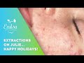 Happy Holidays Blackhead Extractions On Our Dear Friend Julie