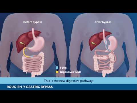 Bariatrische Türkei NAMIK YILMAZ - ROUX EN-Y GASTRIC BYPASS