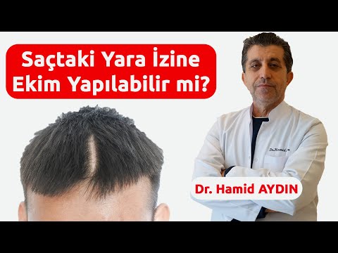Saçtaki Yara İzine Ekim Yapılabilir mi? - Dr. Hamid AYDIN