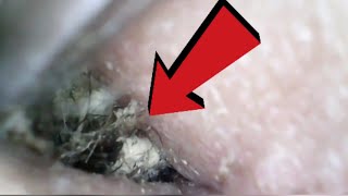 Indian deep belly button cleaning