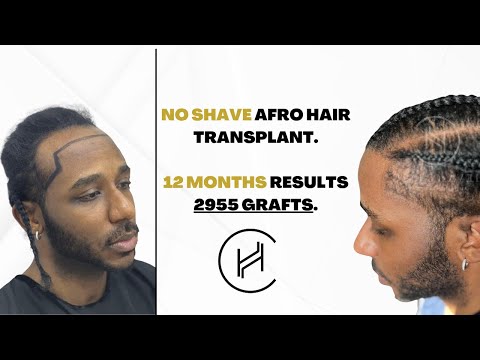 NO SHAVED Afro Hair Transplant Results - 2955 GRAFTS | 12 MONTHS
