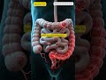 Colorectal Cancer From Polyps To Tumors 3 ColorectalCancer ColonCancer RectalCancer Trending