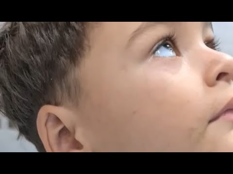 Hyperekplexia, stiff baby syndrome, 🌟 startle reflex, Dr. zuhair