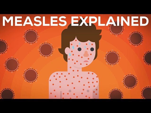 Pronúncia de vídeo de Measles em Inglês