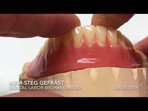 Implantatstege aus NEM