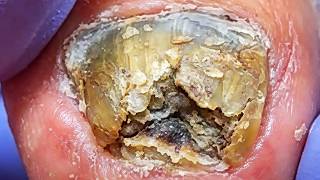 Slowly Peel Off The Bad Nails And Restore The Nail Bed To Health【Xue Yidao】