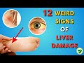 LIVER is DYING! 12 Weird Signs of LIVER DAMAGE | Healthy Buddy