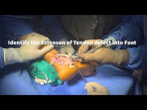 Surgical management of Peroneal tendon rupture by Dr Girish Motwani, Suyog hospital, Nagpur