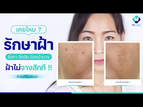 ฉีดผิวขาว