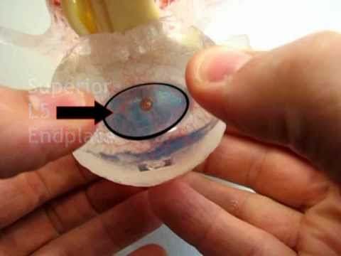 Endplate Fracture by Dynamic Disc Designs Corp.