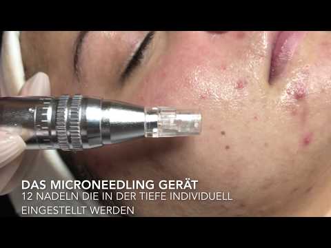 Magnetresonanztomographie der Halswirbelsäule Als treat maxillofacial Gelenk