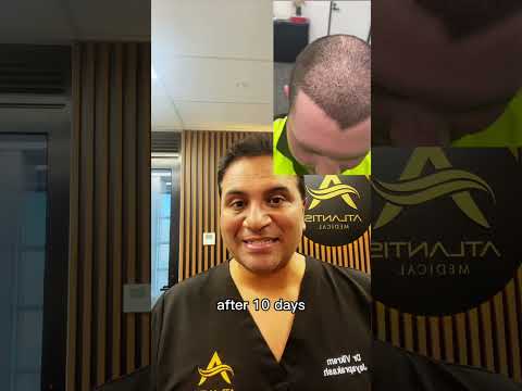 How Long To Recover After A Hair Transplant?