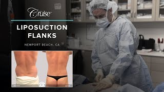 Say Goodbye to Your Muffin Top: Liposuction Flanks for Waist Sculpting | Surgery Video